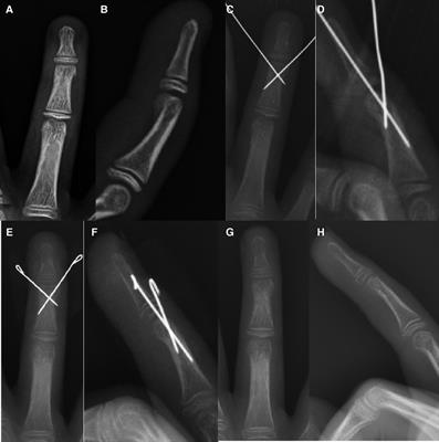 Clinical outcomes of closed, displaced phalangeal neck fractures in children with different types of kirschner wire fixation: A retrospective observational study